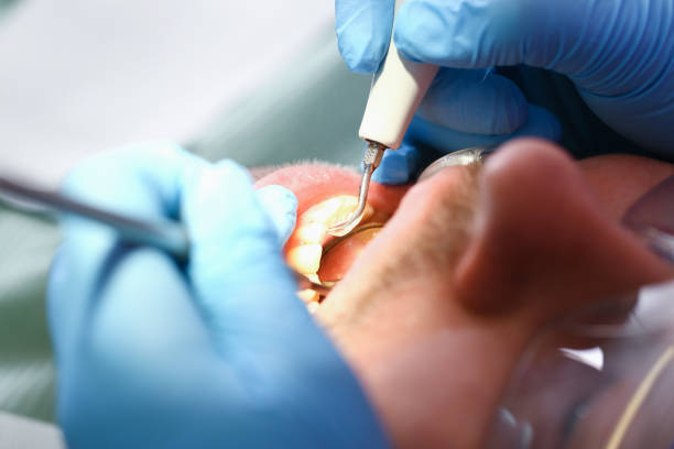 Best Emergency Tooth Extraction in Saylorsburg, PA